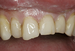 All Ceramic Crowns: Before
