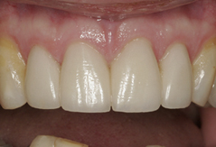 All Ceramic Crowns: After