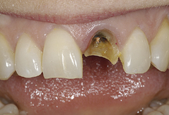 Single Implant Crown: Before